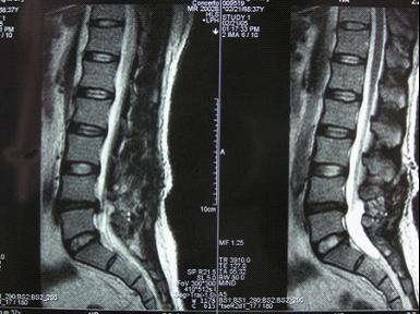 腰 45 椎间盘突出磁共振